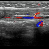 Longitudinal image with color Doppler flow in the same location shows the right inferior epigastric artery and its perforating branches into the rectus abdominis muscle. These are of relevance when this muscle is harvested for a possible flap used for reconstruction.