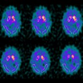 I-123 Ioflupane (DaTscan) SPECT images with axial reformats show segmentation of striata to anterior, mid, and posterior regions. Note significant decrease in radiotracer uptake right mid and posterior segments of right  and mild decrease in left posterior segment . This indicates nigrostriatal neuronal loss in bilateral striata. This cannot distinguish between idiopathic Parkinson disease (PD) and atypical PD.