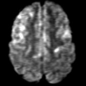 Axial DWI MR shows increased signal in areas of FLAIR hyperintensity. The foci were hypointense on ADC images, indicating diffusion restriction. Both WM and gray matter involvement is present. Diffusion restriction is an uncommon imaging finding and is associated with a worse prognosis.