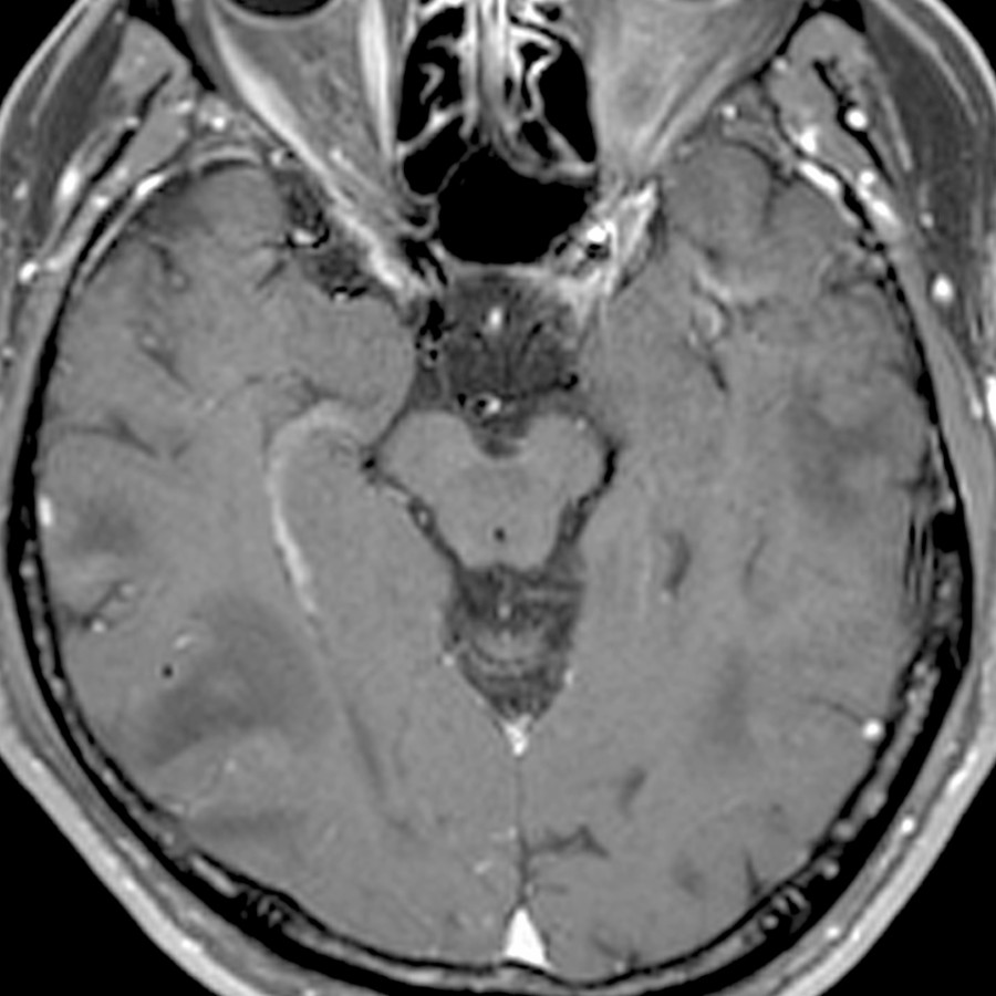 Axial T1 C+ FS MR in the same patient shows no enhancement. Differential considerations include autoimmune encephalitis (AE), acute demyelinating encephalomyelitis (ADEM), viral encephalitis, and vasculitis in this case. AE related to GABAr was diagnosed by CSF and serum markers.