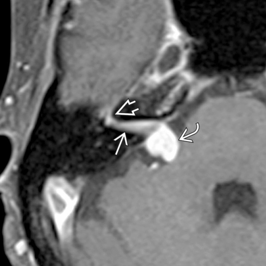 Axial T1 C+ FS MR reveals an enhancing facial nerve schwannoma traversing the CPA  and IAC  into the facial nerve labyrinthine segment . This labyrinthine tail is characteristic.