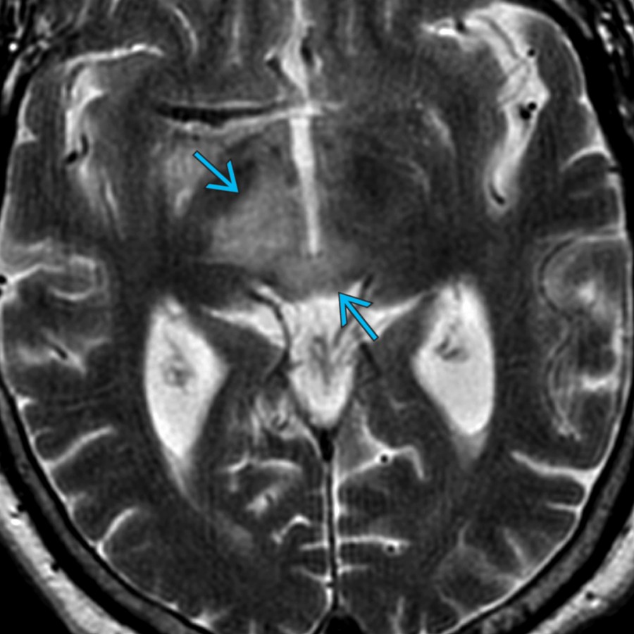 Axial T2 MR shows midbrain hyperintensity  related to brainstem encephalitis, which is characterized by hyperintensity in the midbrain, pons, cerebellar peduncle, and basal ganglia.
