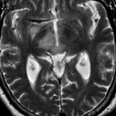 Axial T2 MR shows midbrain hyperintensity  related to brainstem encephalitis, which is characterized by hyperintensity in the midbrain, pons, cerebellar peduncle, and basal ganglia.