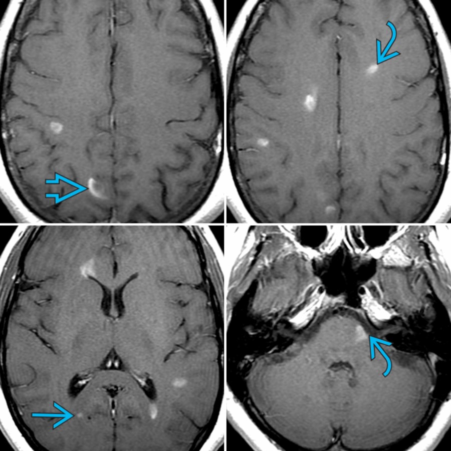 Axial T1 C+ MR in a patient with MS demonstrate multiple enhancing plaques due to active demyelination. Punctate , nodular , and rim patterns    are seen.