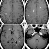 Axial T1 C+ MR in a patient with MS demonstrate multiple enhancing plaques due to active demyelination. Punctate , nodular , and rim patterns    are seen.