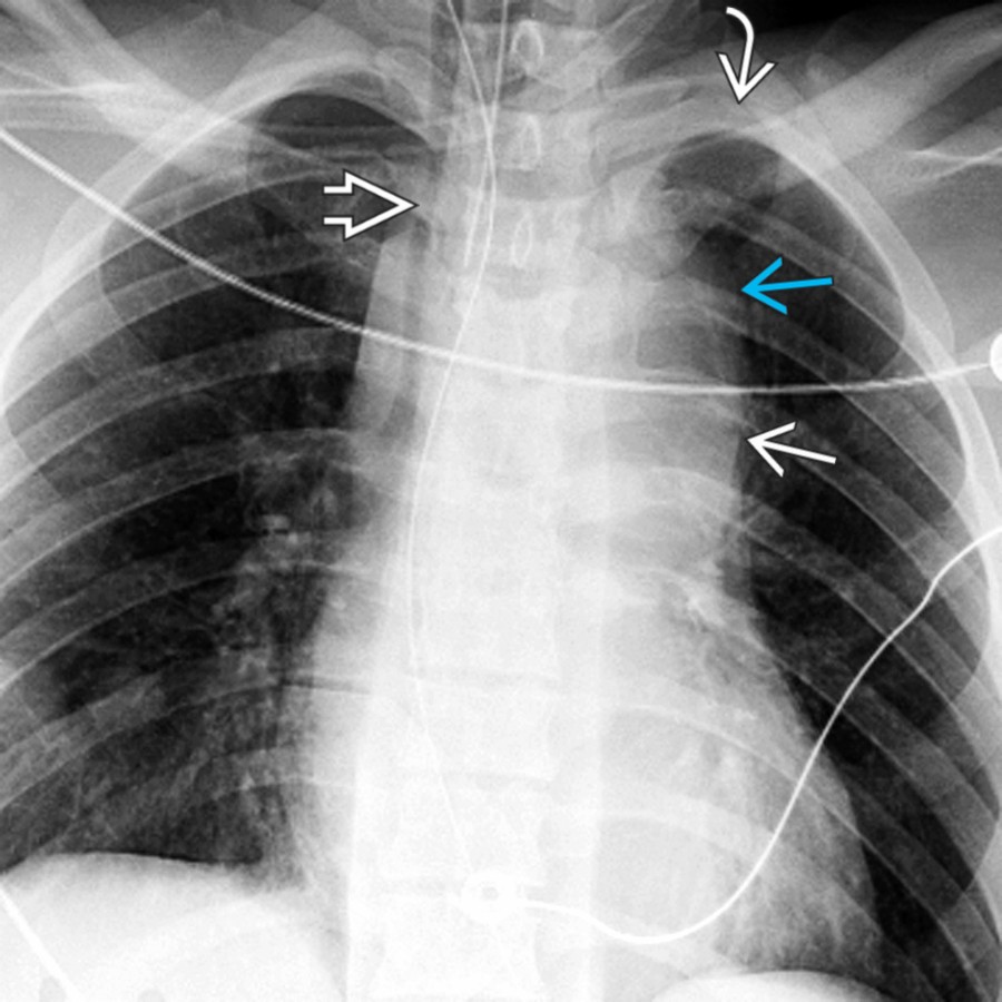 AP chest radiograph in a young man struck by a car shows widening of the superior mediastinum , a left apical cap , a right tracheal/endotracheal and enteric tube deviation , thick paratracheal stripes, and loss of the aortic arch and the AP window .