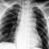 AP chest radiograph in a young man struck by a car shows widening of the superior mediastinum , a left apical cap , a right tracheal/endotracheal and enteric tube deviation , thick paratracheal stripes, and loss of the aortic arch and the AP window .