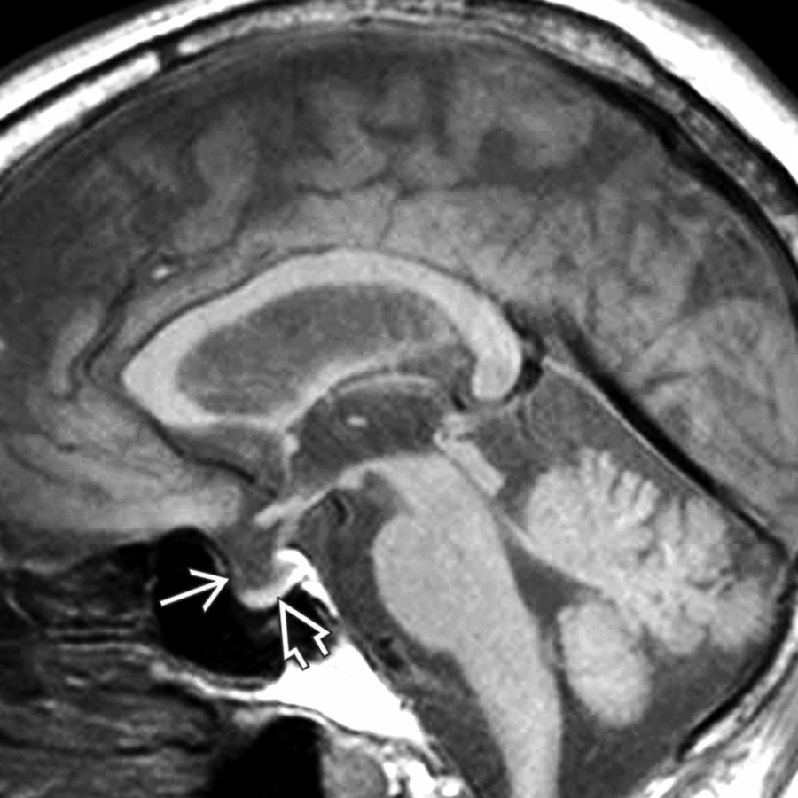 Sagittal T1WI MR shows empty sella with herniation of CSF through the diaphragma sellae , flattening the pituitary gland inferiorly against the sellar floor .