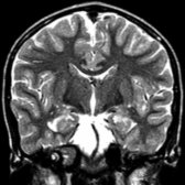 Coronal T2WI MR of the same patient at 9 years of age shows abnormal hypointense signal in the globus pallidus  and substantia nigra .