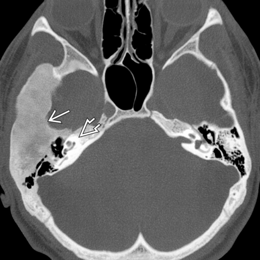 Axial bone CT shows expansile ground-glass density focus of fibrous dysplasia  affecting the squamous, tympanic, & mastoid portions of the T-bone. Note relative sparing of the otic capsule .