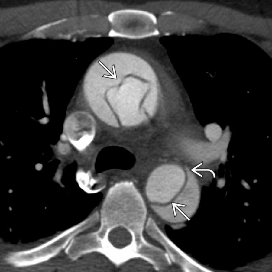 Axial CECT shows acute type A aortic dissection with flap  that is convex toward false lumen . Note that a beak sign  is present in the false lumen. The appearance of a beak sign is attributed to the higher systolic pressure in the true lumen.
