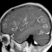 Sagittal T1 C+ MR in the same patient shows extensive irregular ring enhancement  in multiple subcortical WM lesions. Acute hemorrhagic leukoencephalopathy (AHL) is a rare manifestation of ADEM occurring in 2% of cases. AHL is associated with a very poor prognosis. Aggressive therapeutic management is a prerequisite to avoid usual disease course with fatal outcome.