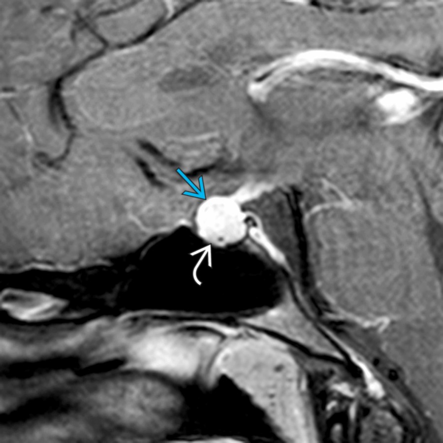 Sagittal T1 C+ MR shows a small, shallow sella turcica . This causes the normal-sized pituitary gland  to protrude superiorly, mimicking a macroadenoma. The overall height of the pituitary gland was normal at 10 mm in this young patient.