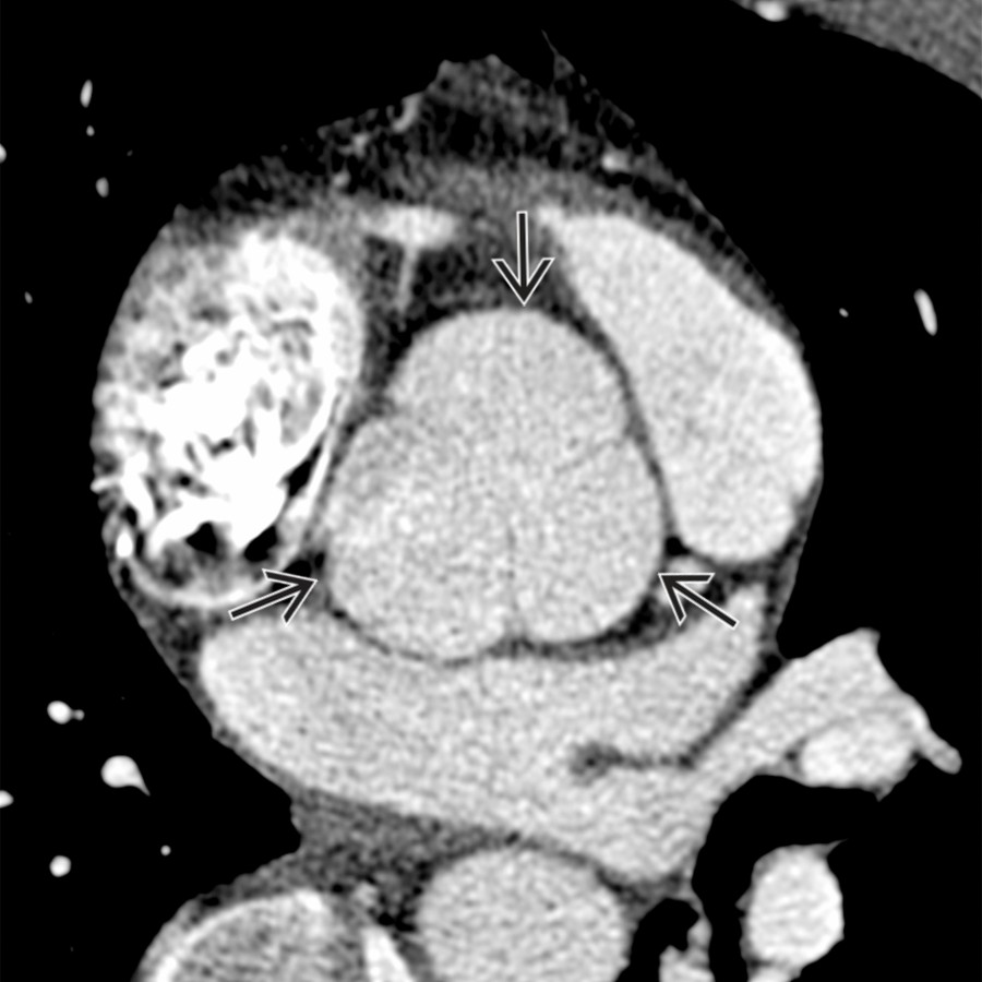 Axial chest CTA in the same patient shows dilatation of the sinuses of Valsalva  (4.7.x 5.0 x 5.0 cm). Three measurements bisecting each sinus are usually obtained at this level.