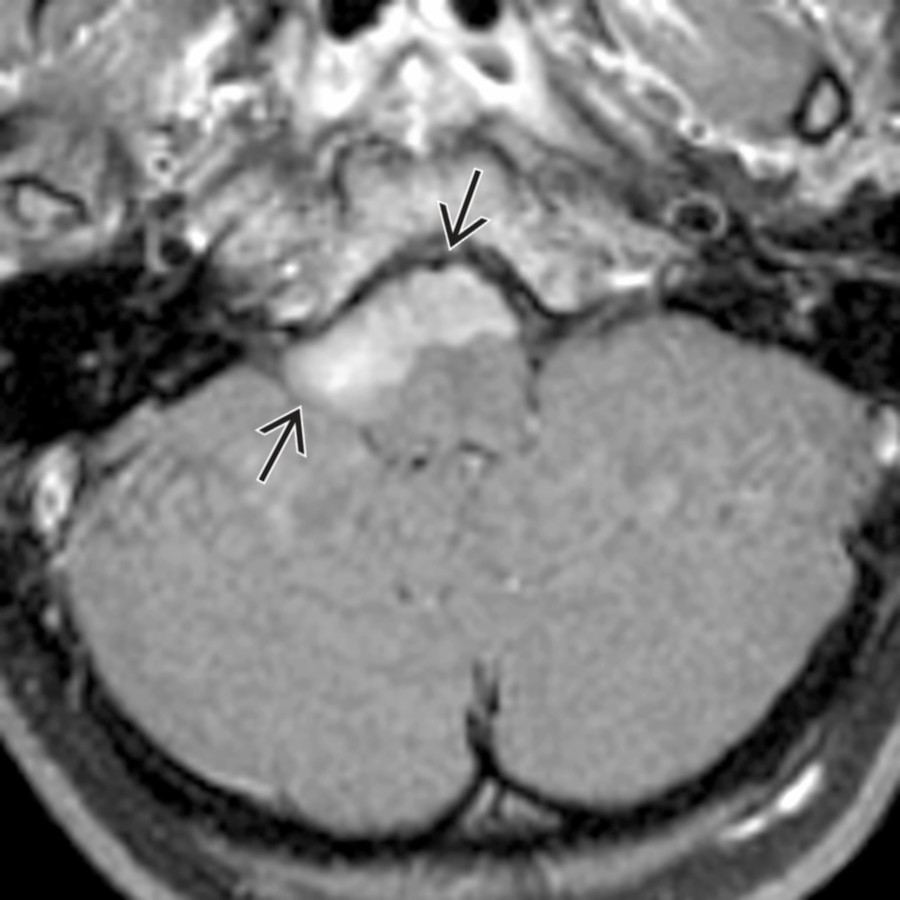 Axial T1WI C+ MR shows a neurenteric cyst encroaching  upon the prepontine cistern. Although most often these are located anteriorly, they may arise posteriorly at the cisterna magnum.