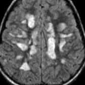 Axial FLAIR MR shows multiple bilateral, asymmetric, flocculent, hyperintense lesions of acute disseminated encephalomyelitis.