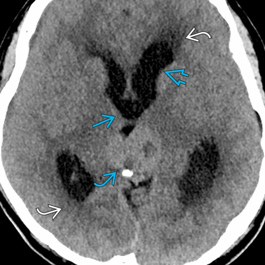 Axial NECT in a patient with pineal region germinoma  shows marked dilatation of the lateral ventricles  and anterior 3rd ventricle  with periventricular halo   and diffuse effacement of the cortical sulci.