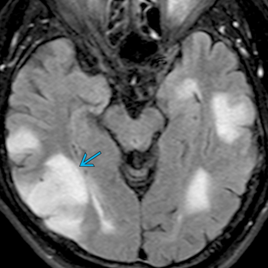 Axial FLAIR MR in a 61 year old with multiple myeloma who presented with seizures shows abnormal hyperintensity  in the cortex and subcortical white matter of the temporal lobes.