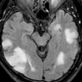 Axial FLAIR MR in a 61 year old with multiple myeloma who presented with seizures shows abnormal hyperintensity  in the cortex and subcortical white matter of the temporal lobes.