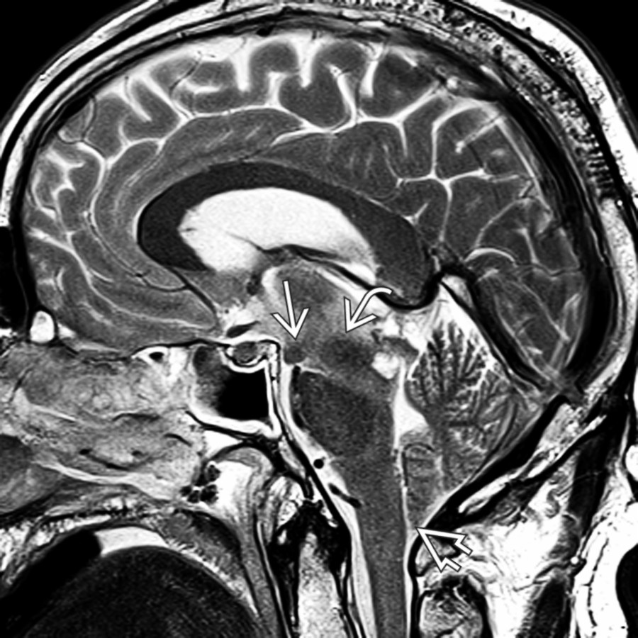 T2 MR in a 57-year-old man treated for migraine headaches shows severe midbrain slumping , downwardly displaced cerebellar tonsils , and "draping" of the hypothalamus over the dorsum sellae with mammillary bodies  below the dorsum.