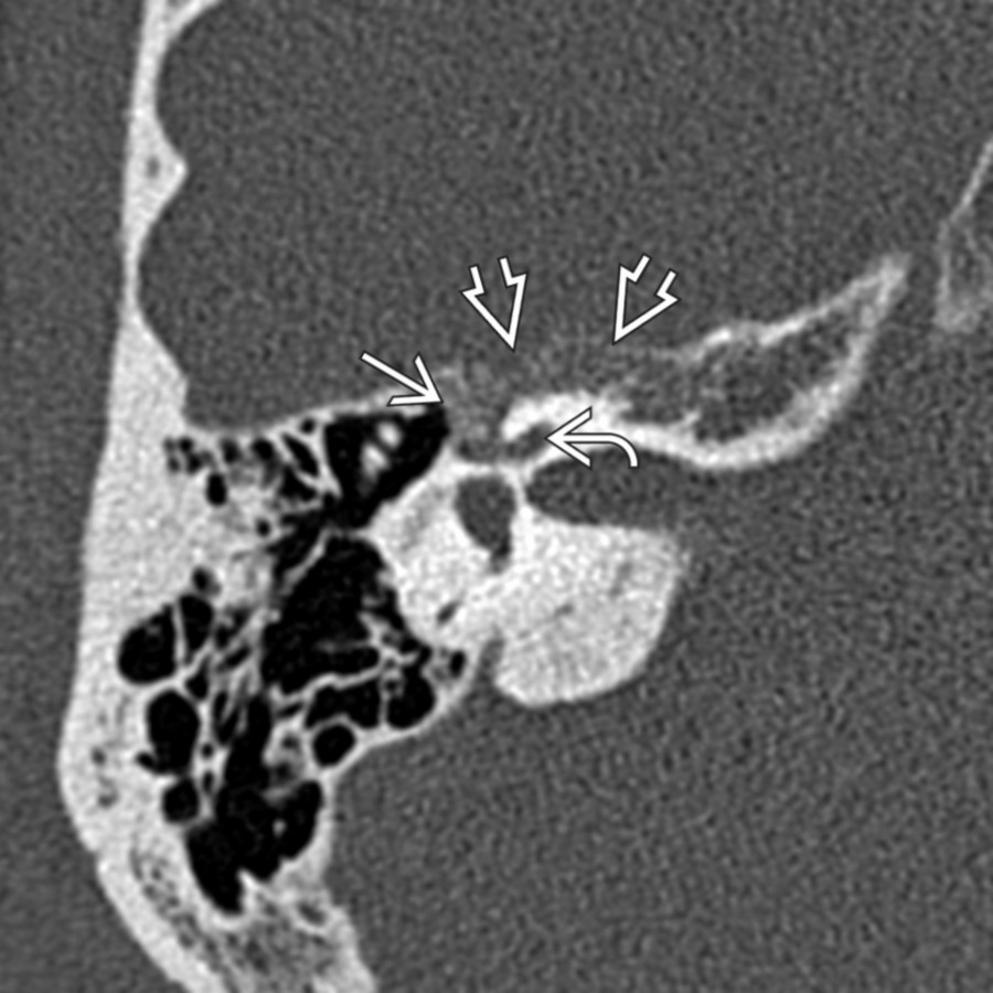 Axial bone CT through the right temporal bone demonstrates a medium-sized FNVM in the geniculate fossa  with extension along the anteromedial surface of the temporal bone . The crescentic shape of this lesion arching around the cochlea  medially on the anterior temporal bone surface is typical of FNVM.