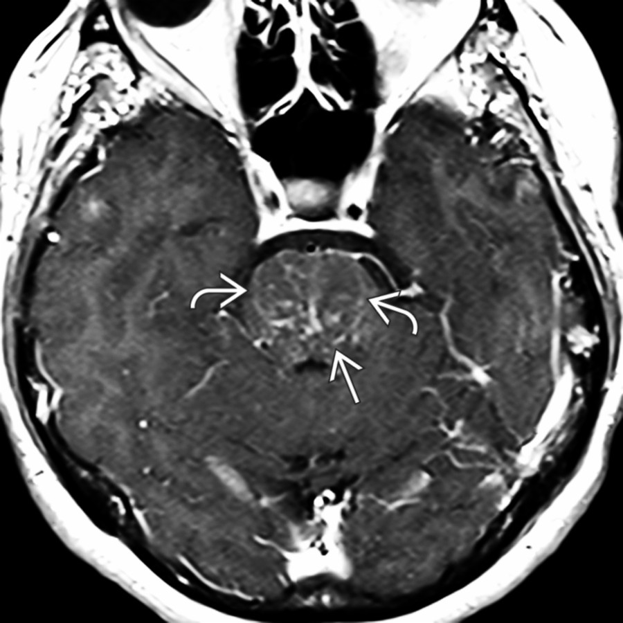 More cephalad T1 C+  MR scan in the same patient shows the punctate  and curvilinear  lesions involving the upper pons.
