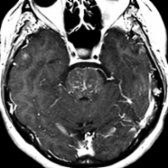 More cephalad T1 C+  MR scan in the same patient shows the punctate  and curvilinear  lesions involving the upper pons.