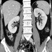 Coronal correlative CECT shows the paralumbar location of the psoas muscles and their medial location relative to the kidneys. The psoas muscles originate from the lumbar and 12th thoracic vertebral bodies and their transverse processes and run past the pelvic brim, where they course inferolaterally to be joined by the iliacus muscle.