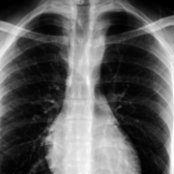 PA radiograph shows subtle areas of rib notching . Note the rapid narrowing of the proximal descending thoracic aorta , which then returns to normal size more distally .