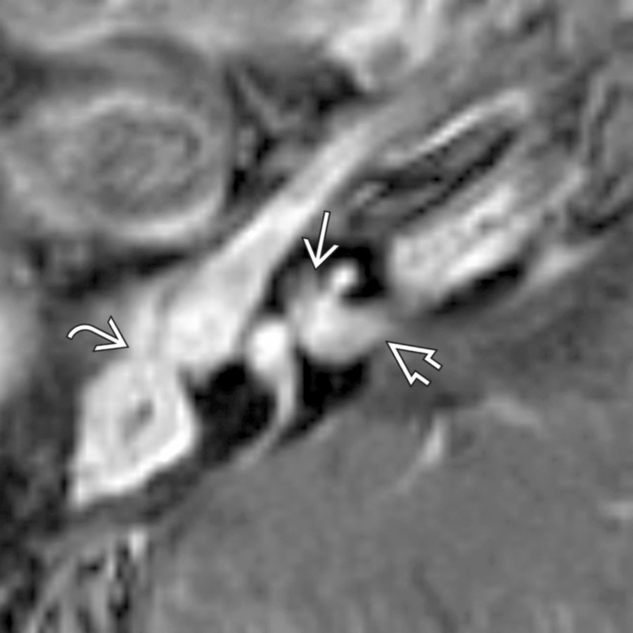 Axial T1 C+ FS MR shows enhancement of the middle ear , inner ear membranous labyrinth , and IAC  in this pediatric patient with acute actinomycosis.