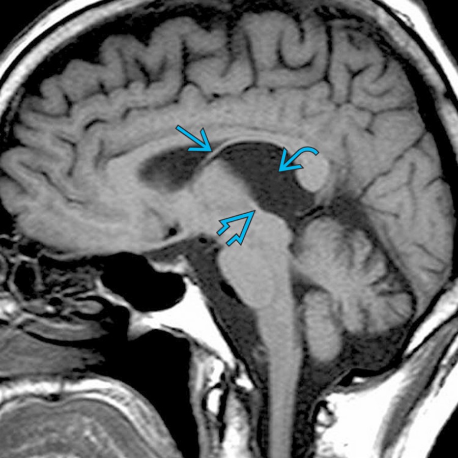 Sagittal T1 MR shows a classic CVI  as a CSF-like enlargement that elevates the fornix  and flattens and displaces the internal cerebral vein  inferiorly. These are usually asymptomatic; however, large ones can cause CSF obstruction and can be treated by fenestration.