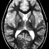 Axial T2WI MR shows the classic eye of the tiger appearance of PKAN. The globus pallidi are abnormally hypointense with central foci of hyperintensity , resembling a tiger's eyes.