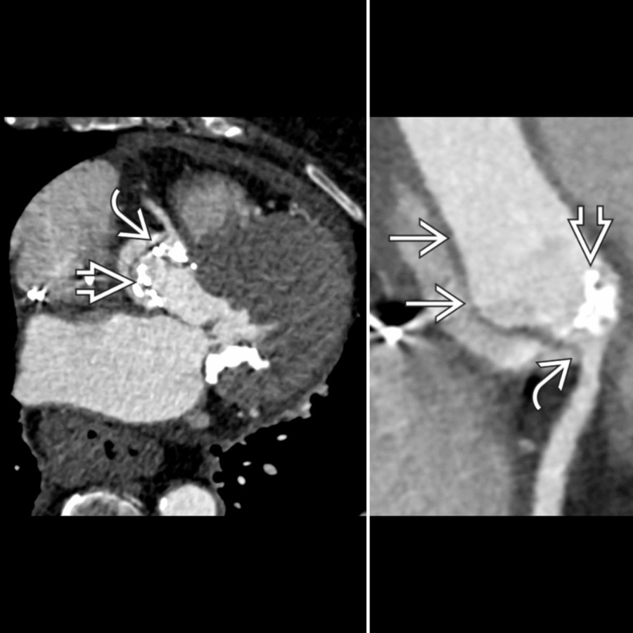 Axial (left) and oblique (right) CTA demonstrate a type A aortic dissection  involving the right coronary artery ostium  in a patient status post percutaneous aortic valve implantation/replacement  (TAVI/R).