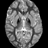 Axial T2* GRE MR in the same patient at 9 years of age shows blooming of the hypointense signal in the globus pallidus secondary to the paramagnetic effect of iron. The findings in this patient are typical of the evolution of classic PKAN: Diminishing caliber of the "eye," increasing surrounding pallidal hypointensity, and progressive volume loss.