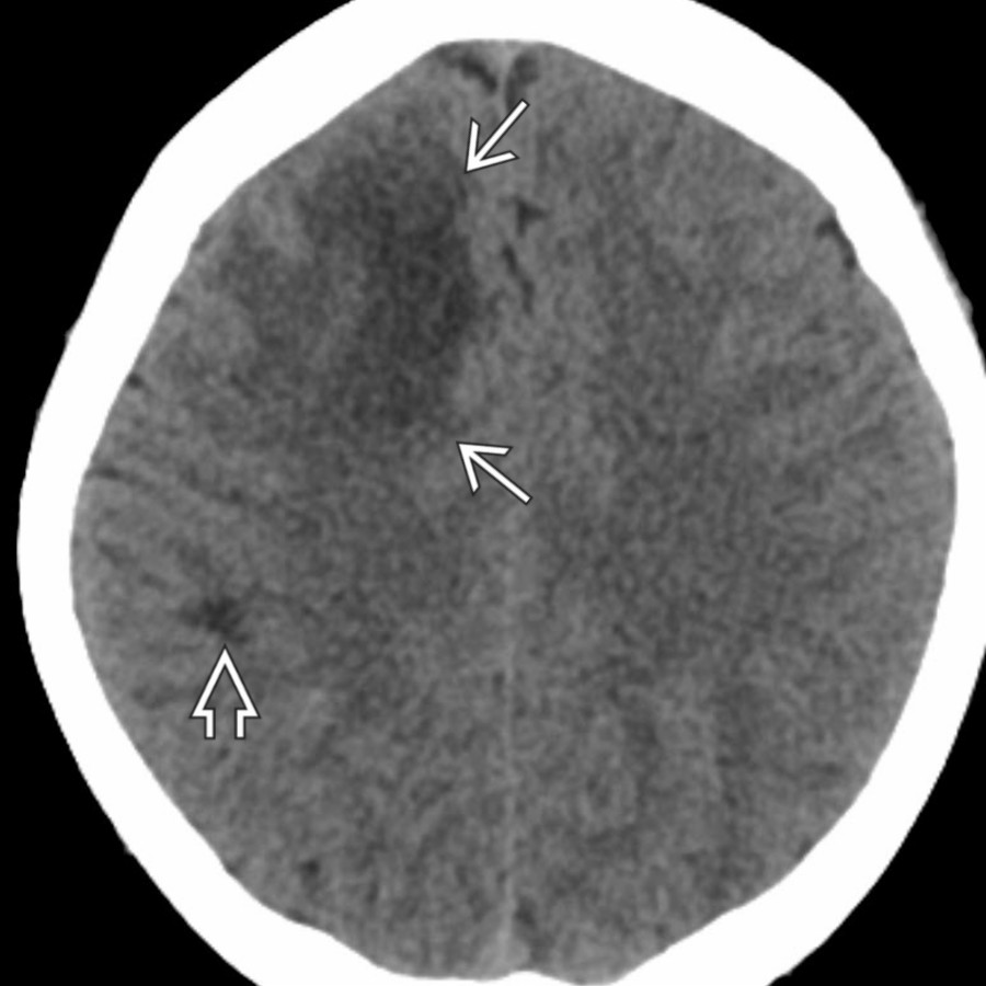 Axial NECT in a 16-year-old with progressive left-sided weakness after minor trauma shows a large, low-attenuation white matter lesion in the anterior right frontal lobe  & a smaller one near the right motor strip .