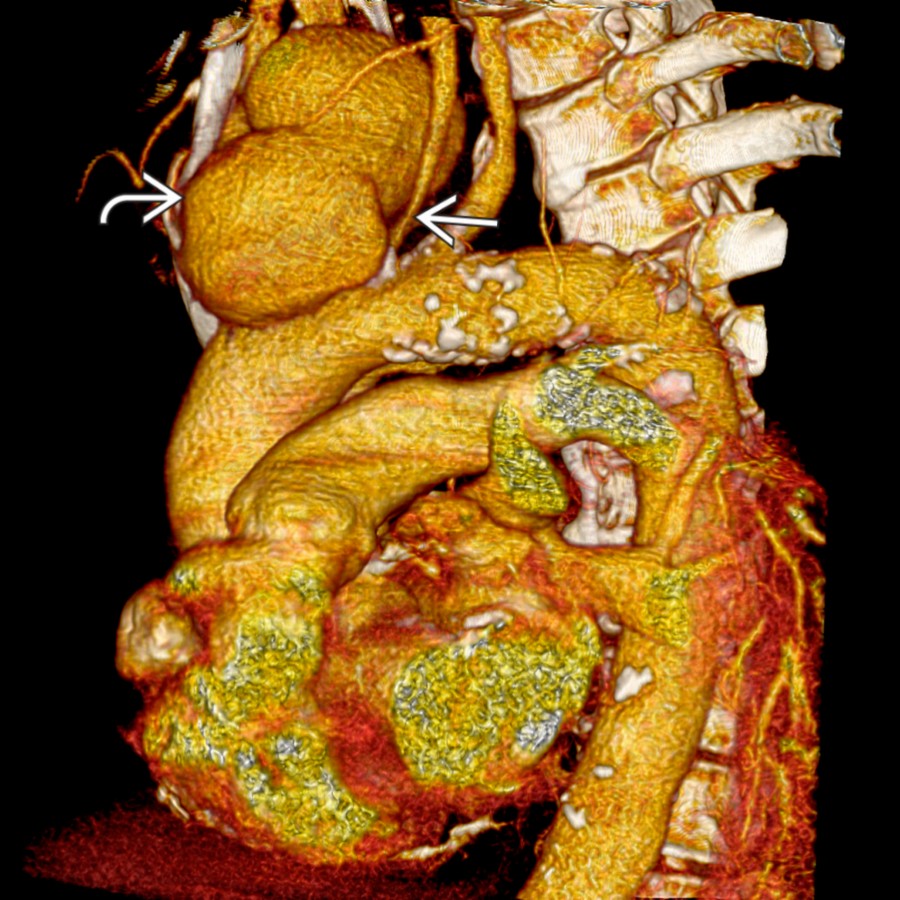 Volume-rendered CTA in the same patient shows the large pseudoaneurysm , which is compressing the proximal left carotid artery . Volume renderings may be helpful to thoracic surgeons for surgical planning.