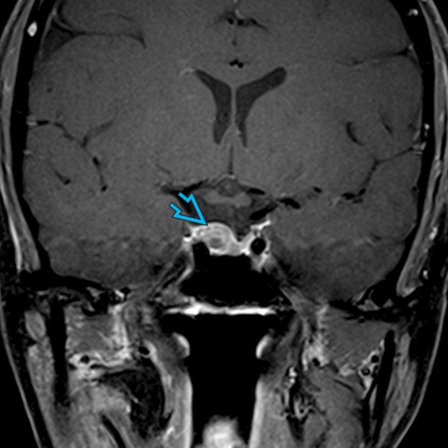 Coronal T1 C+ FS MR in a 55-year-old woman shows a mildly enlarged right pituitary gland  related to a prolactin secreting microadenoma. Microadenomas are benign tumors of the adenohypophysis that are often seen best on dynamic contrast MR.