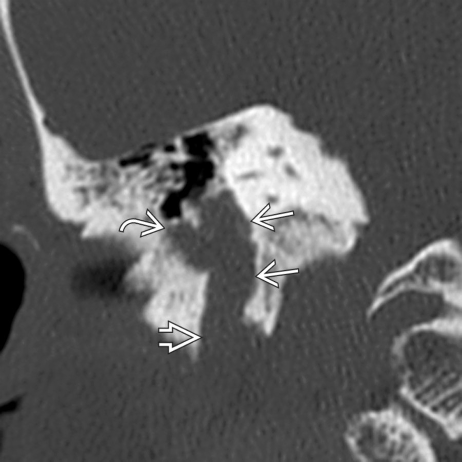 Coronal bone CT in the same patient demonstrates that the FNS also involves the mastoid CNVII , exiting the enlarged stylomastoid foramen  inferiorly. The tumor has broken into adjacent air cells  on its lateral margin.