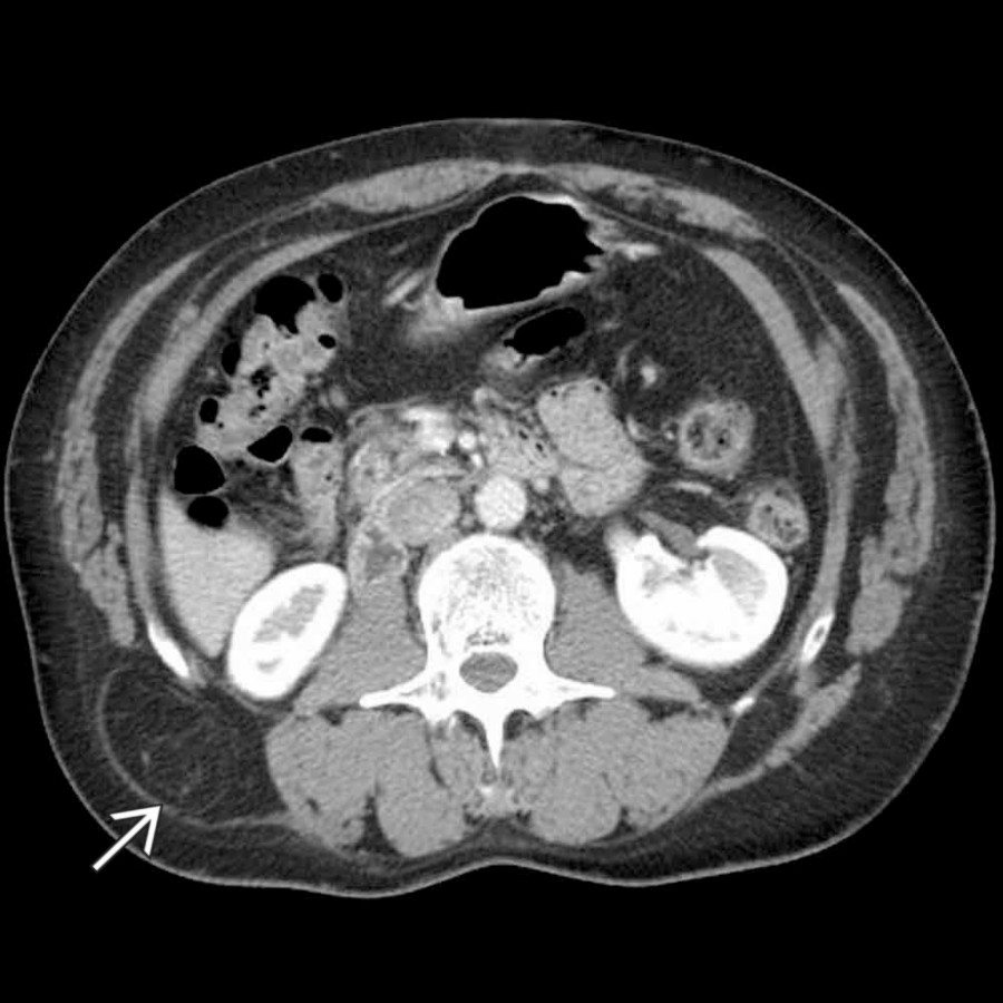 Axial CECT demonstrates a defect in the thoracolumbar fascia on the right side    through which retroperitoneal fat herniates. The site of herniation is just cephalad to the insertion of the fascia on the iliac crest, classic for a lumbar hernia.