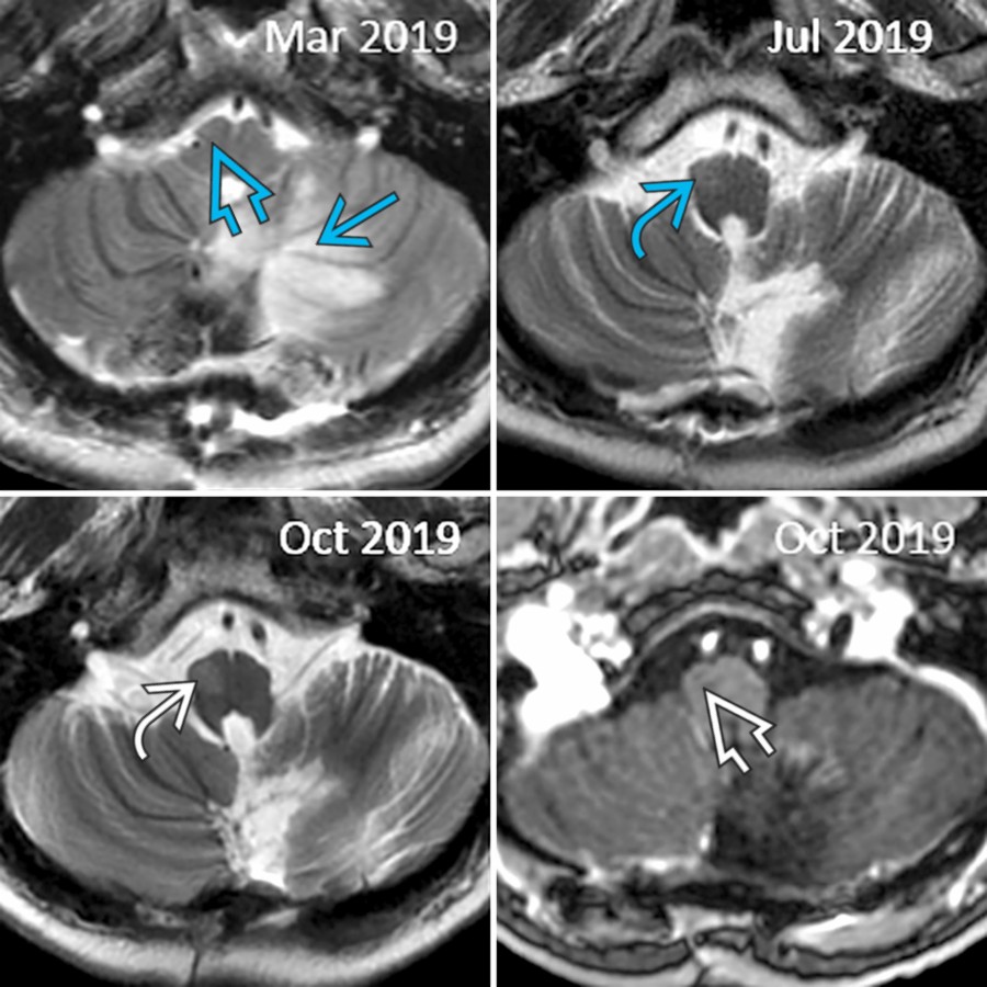 Axial T2 MR at 1 day (top left), 4 months (top right), and 7 months (bottom left) postoperative follow-up show edema in left DN  and normal right olive . Note light enlargement and ↑ signal in right olive , progressive enlargement and ↑ signal in olive  , and lack of enhancement in olive  on postcontrast T1WI (bottom right).