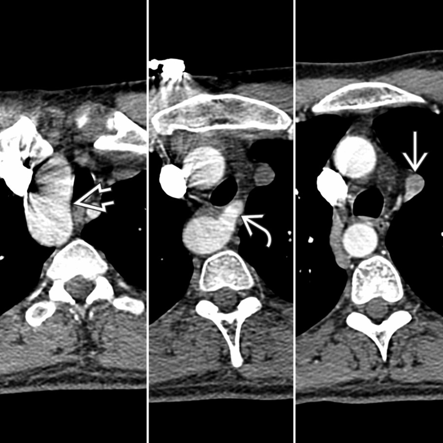 Axial chest CTA in an asymptomatic patient with RAA , ALSA , and descending thoracic aorta on the right reveals an incidentally noted persistent left superior vena cava  draining into the coronary sinus.
