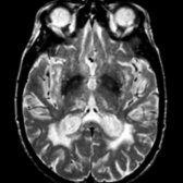 Axial T2WI MR reveals bilateral thalamic lacunar infarctions , as well as confluent periventricular white matter hyperintensity. Note the ventricular enlargement from associated atrophy.
