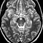 Axial T2WI MR in the same patient shows hypointense substantia nigra . Nigral hypointensity is usually greater in patients with NBIA other than PKAN.