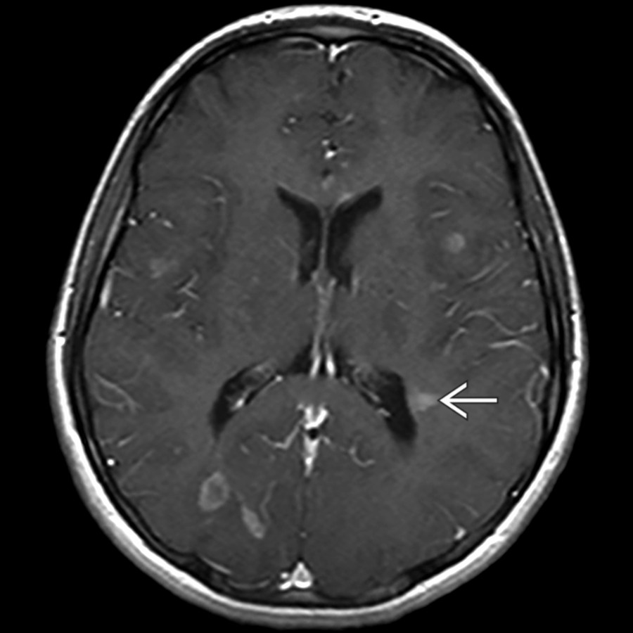 Axial T1 C+ MR in the same patient confirms ring- and solid-enhancing demyelinating lesions, including a characteristic perpendicular periventricular lesion .