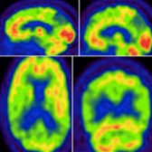 Sagittal (top row), axial (bottom left) and coronal (bottom right) reformats of FDG PET in a patient with VaD show hypometabolic areas due to remote territorial infarcts  and chronic WM ischemic changes . (Courtesy J. Singh, MD.)