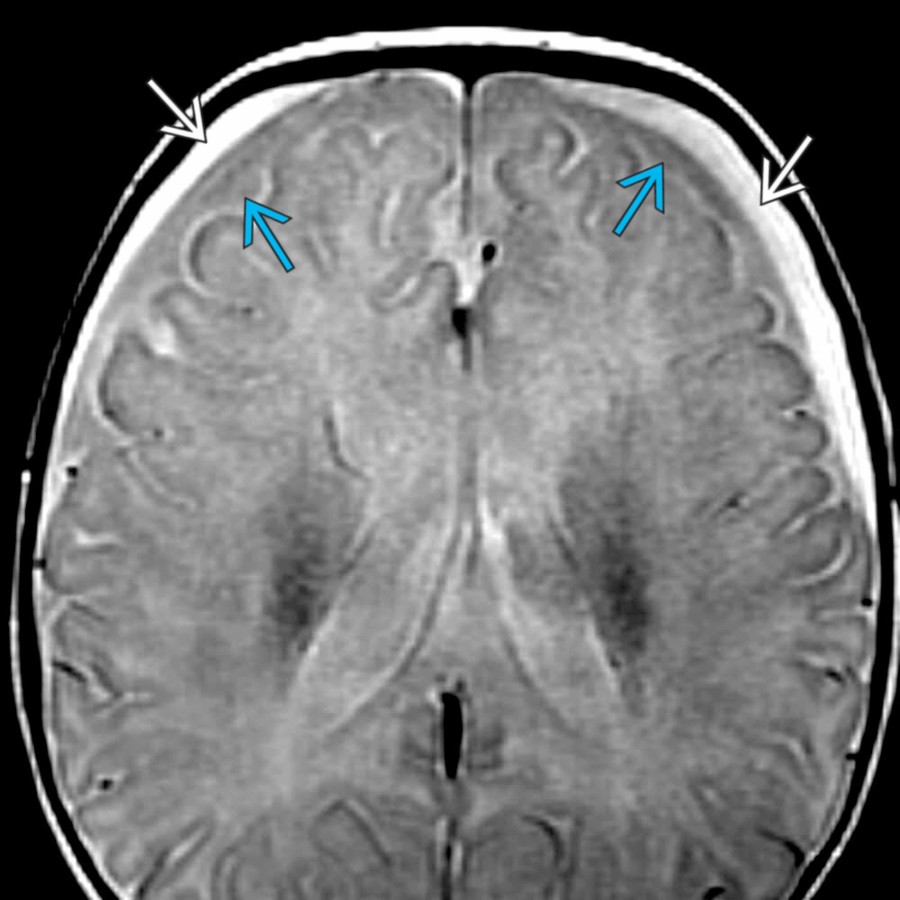 Axial PD MR in a 4-month-old girl with macrocrania shows enlarged SAS , which are isointense to the brain. Also note the small, bilateral, nonhemorrhagic, hyperintense subdural fluid collections .