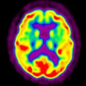 More inferior axial F-18 FDG PET in the patient with MCI shows further evidence of hypometabolism of the posterior parietal  and frontal  cortices. Importantly, there is characteristic sparing of the sensorimotor region  and visual cortex .