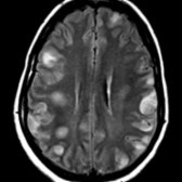 Axial FLAIR MR shows numerous peripheral WM and cortical lesions that exhibited robust contrast enhancement in an 18-year-old woman with malignant (Marburg) MS. The patient presented with a 2-week history of behavioral changes and leg pain and died 3 weeks after presentation. Autopsy showed typical demyelinating pathology.