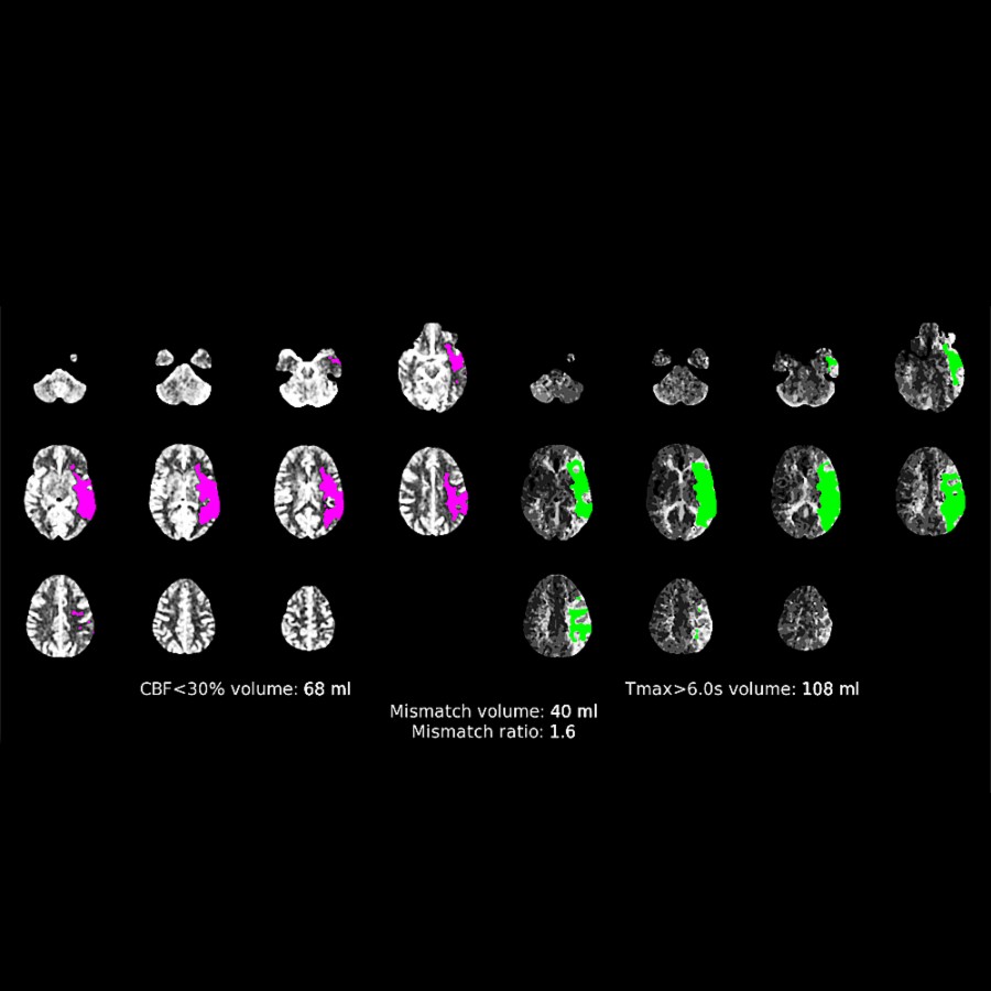 Automated CT perfusion in the same case shows CBF < 30% = 68 mL, volume of brain with Tmax > 6.0 seconds = 108 mL, and mismatch volume (penumbra) of 40 mL.