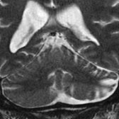 Coronal T2 TSE through the posterior fossa in the same patient shows asymmetric atrophy with shrunken folia & prominent fissures  of the left cerebellar hemisphere contralateral to supratentorial insult due to crossed cerebellar diaschisis (CCD).